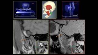 DYNAMICMRI  ATM [upl. by Dlanger]