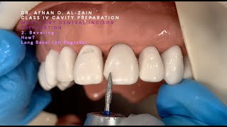 Class IV preparation and beveling – Maxillary central incisor 21  Arabic عربي [upl. by Artemis]