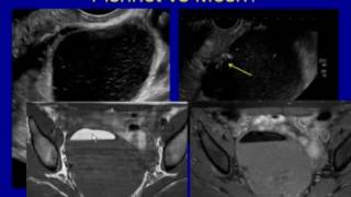 Hemorrhagic Cysts and Torsion Acute Female Pelvis [upl. by Ainig]