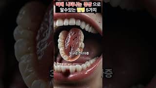 혀에나타나는증상으로알수있는질병건강혀가알려주는질병건강정보a disease that can be identified by the symptoms of the tongue [upl. by Anifad366]