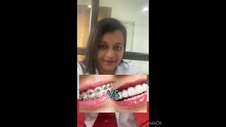 Braces or Aligners How to choose [upl. by Aliza86]