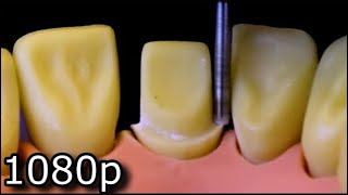 All Ceramic Crown Preparation For Upper Central Maxillary Incisor [upl. by Asile505]