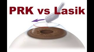 PRK VS Lasik Hindi [upl. by Zach]