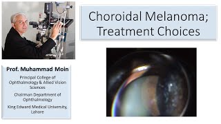 Choroidal Melanoma Treatment Choices [upl. by Boar]