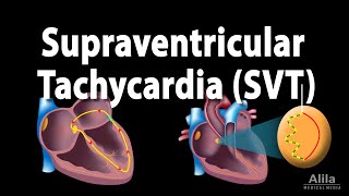 Supraventricular Tachycardia SVT PSVT Animation [upl. by Ahsias]