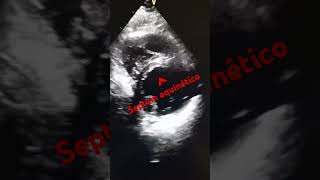 ANTEROSEPTAL FACE INFARCTION echocardiogram infarto anteroseptal [upl. by Annat292]