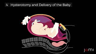 Primary Low Transverse CSection Steps [upl. by Nodmac]