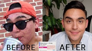 My Acne Journey ROACCUTANE [upl. by Andria]