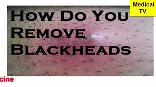 How to remove blackheads [upl. by Lizzy427]