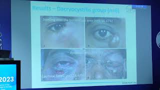 AIOC2023 Freepaper Lacrimal FP2133 topic Sphingomonas paucimobilis related lacrimal infections [upl. by Eenad]