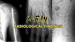 Radiological Findings Spine Shoulder and Feet  A Comprehensive Analysis  november [upl. by Popele492]