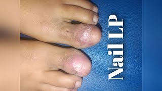 IL TRICORT FOR NAIL LICHEN PLANUS [upl. by Dave]