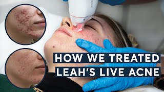 How did we treat Leahs Live Acne [upl. by Ahsiekin]