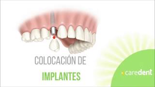 Implantología dental en Caredent [upl. by Aubyn]