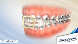 Corrección de mordida y espacios dentales quotOrtodonciaquot [upl. by Ailesor]