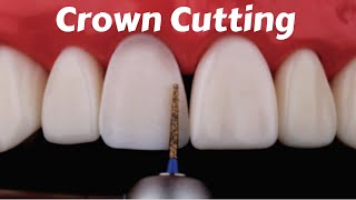 Crown Tooth Preparation Cutting for Anterior Incisor PFM Zirconia Ceramic Emax  Prostho Lecture [upl. by Kerekes]