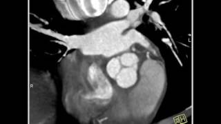 4D Imaging of the Aortic Valve 3D and 4D rendering of the heart 1 of 3 [upl. by Twila583]