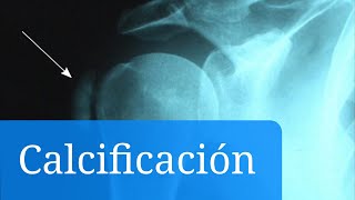 Calcificaciones Cuáles son los síntomas y el tratamiento de las complicaciones [upl. by Colby126]