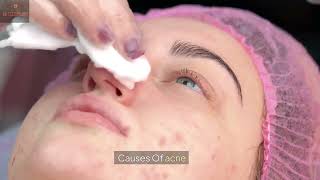 Causes And Symptoms Of Acne [upl. by Einor]