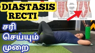 Diastasis Recti  How to Test பிரசவத்திற்குப் பிறகு வரும் தொப்பையை சரிசெய்யும் முறை [upl. by Cacie]