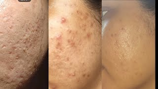 My tretinoin journey before after photos with results [upl. by Colston]