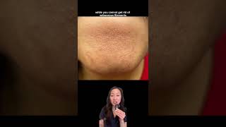 sebaceousfilaments blackheads comedones pores dermatologistskincare skincaretips derm [upl. by Ilke]