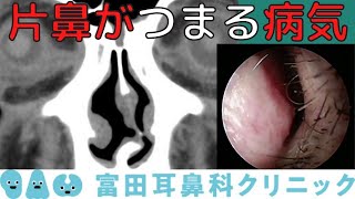 片鼻だけつまる場合に考える病気を解説 [upl. by Veno]