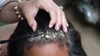 Dry scalp and lice removal technique 🤮🤮🤮🤮🤮🤮🤮🤮🤮🤮🤮🤮🤮🤮🤮🤢🤢🤢🤢🫢🫢🫢🫢🫢 [upl. by Dinnie]