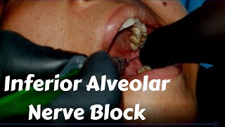 Inferior Alveolar nerve Block Injection in dentistry Landmark amp Technique in Dental Teeth Surgery [upl. by Selda]