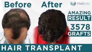 Hair Transplant in Grade 4 Baldness  Perfecti Hair transplant 3578 Grafts Implanted  Medlinks [upl. by Yllet406]