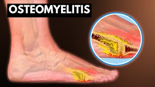 Osteomyelitis What You Need To know [upl. by Seraphina]