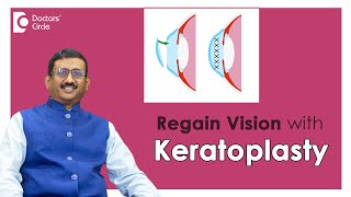 RESTORE VISION with CorneaEye Transplant SurgeryKeratoplastyDrSriram RamalingamDoctors Circle [upl. by Pavlov489]