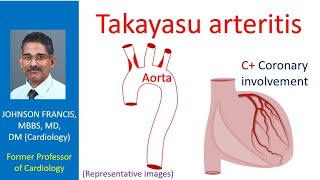 Takayasu Arteritis [upl. by Whitelaw]