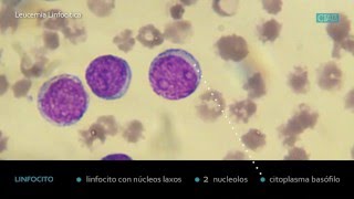 Leucemia Linfocitica Crónica CIAB wwwciabes [upl. by Oballa]