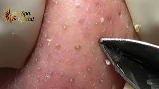 Best Satisfying Nose Plucking Blackheads Whiteheads Removal  Acne Treatment 50 [upl. by Ruyle]