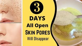 3 Days and All Open Pores Will Disappear from Your Skin Forever [upl. by Creamer460]