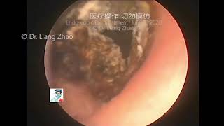 The cleaning process of middle ear cholesteatoma for 12 minutes [upl. by Dante983]