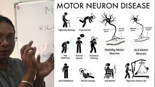 motor neurone diseaseamyotrophic lateral sclerosis [upl. by Lukin]