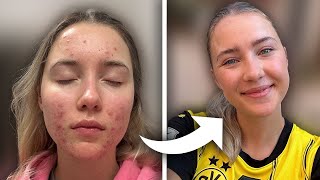 Healing severe acne within 12 weeks Testimonial Lena Hausherr [upl. by Sholom]