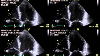 TRUE SEVERE AORTIC STENOSIS  STRESS ECHOCARDIOGRAPHY cardiac ultrasound [upl. by Purdum]