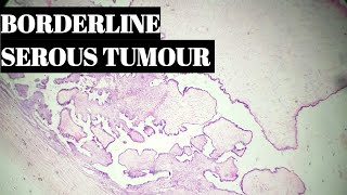 Borderline Indeterminate Serous Tumour Of Ovary Histopathology [upl. by Mcquade]