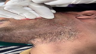 The Secret to Successful White Beard Permanent Removal AWISH Clinic whitebeard viral shorts [upl. by Epuladaug]