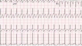 21 Heart Block  Dr Sriram [upl. by Alsworth]