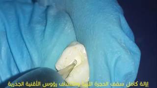 Pulpotomy in Extracted Primary Tooth [upl. by Mairym]