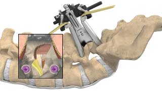 MAS® TLIF Patient Animation [upl. by Endaira]