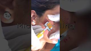 Microneedling at Home Unlock Flawless Skin with This Ultimate DIY Guide  transformation skincare [upl. by Aihcropal984]