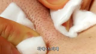 혐오주의  등피지 짜기  ☞Dislike Back fingers☜ [upl. by Loella]