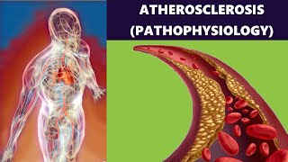 Atherosclerosis – Artery Disease Plaque Formation Risk Factors and Prevention Pathophysiology [upl. by Terrab745]