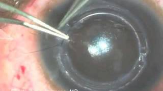 Intacs Insertion for Keratoconus [upl. by Cornie998]