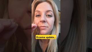 Eczema update3 days after flare up on my face manifested [upl. by Elik]